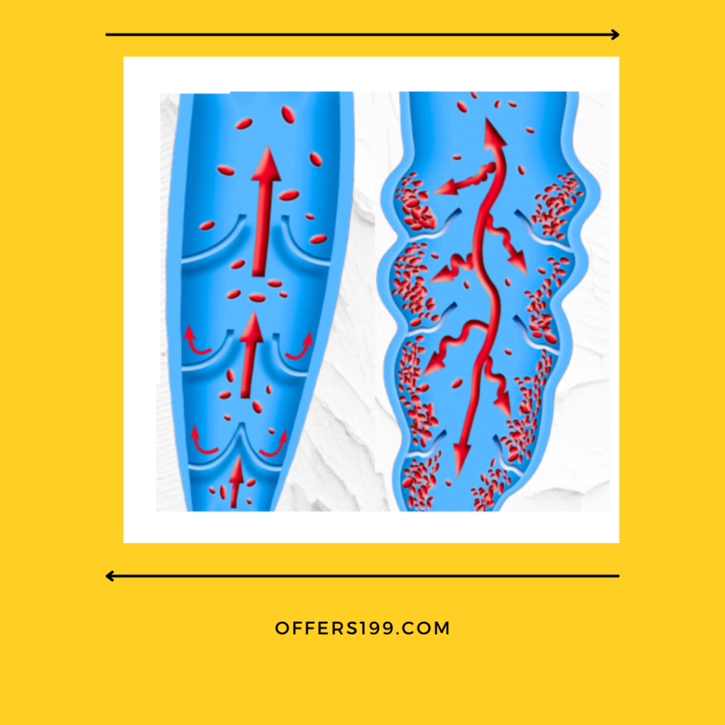 Varicose Veins