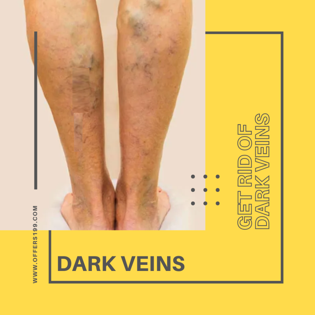 Dark Veins